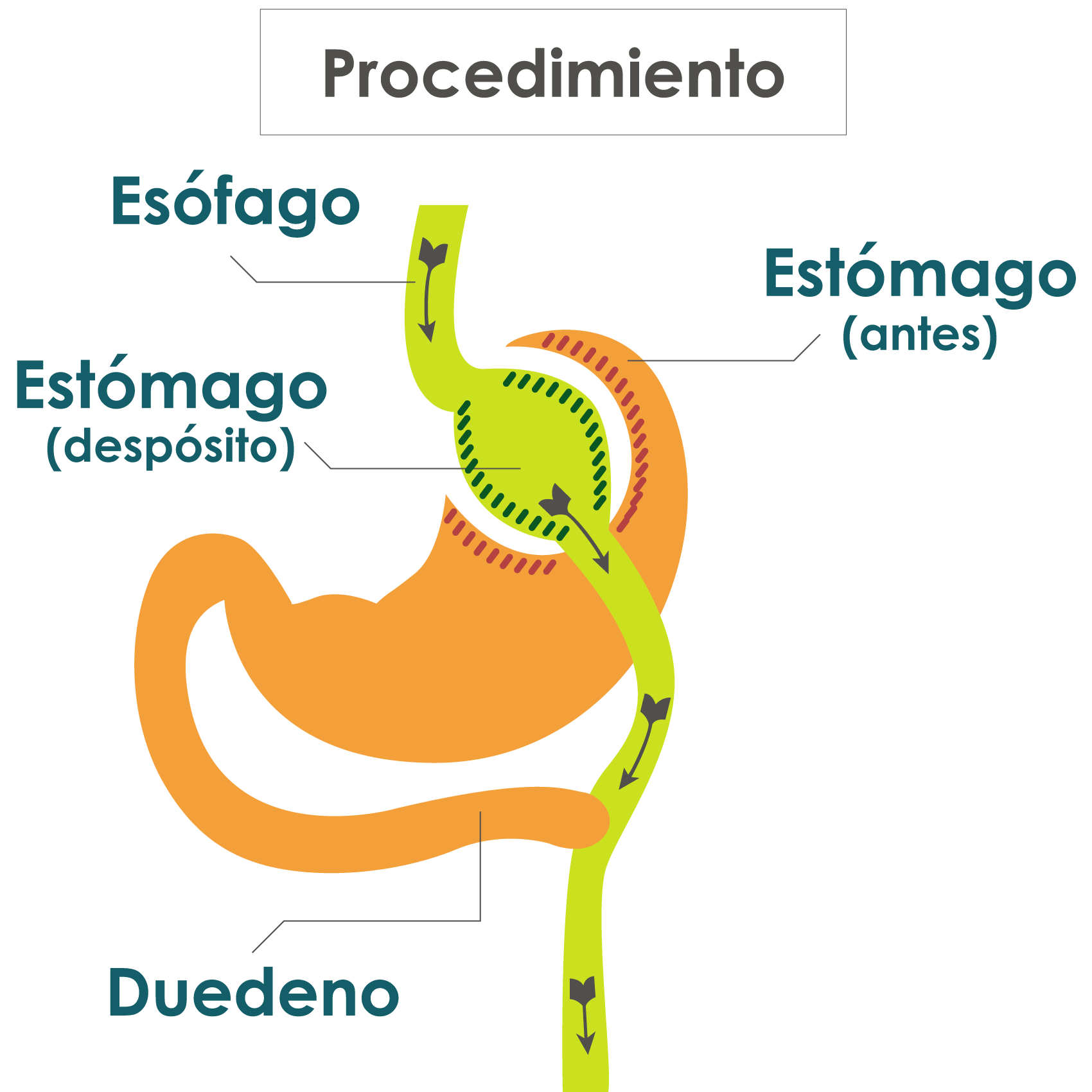 Gastric Bypass - Medellín Colombia - A Good Positive Health Is A New Life